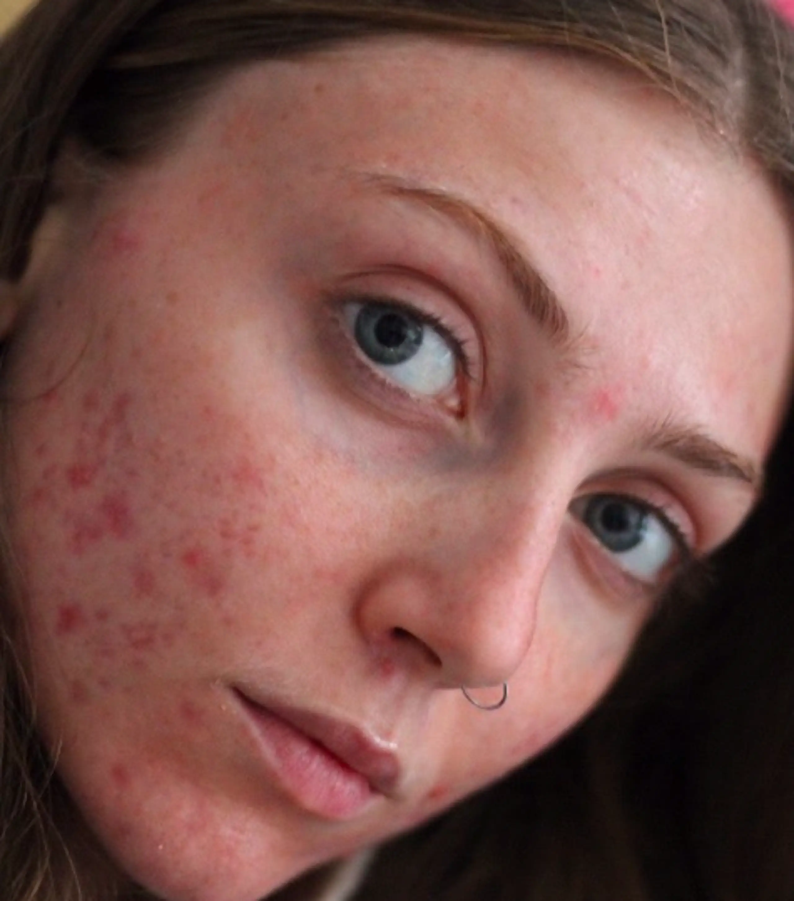 Britains' Next Top Model star Lou Northcote acne (Credit: Instagram)