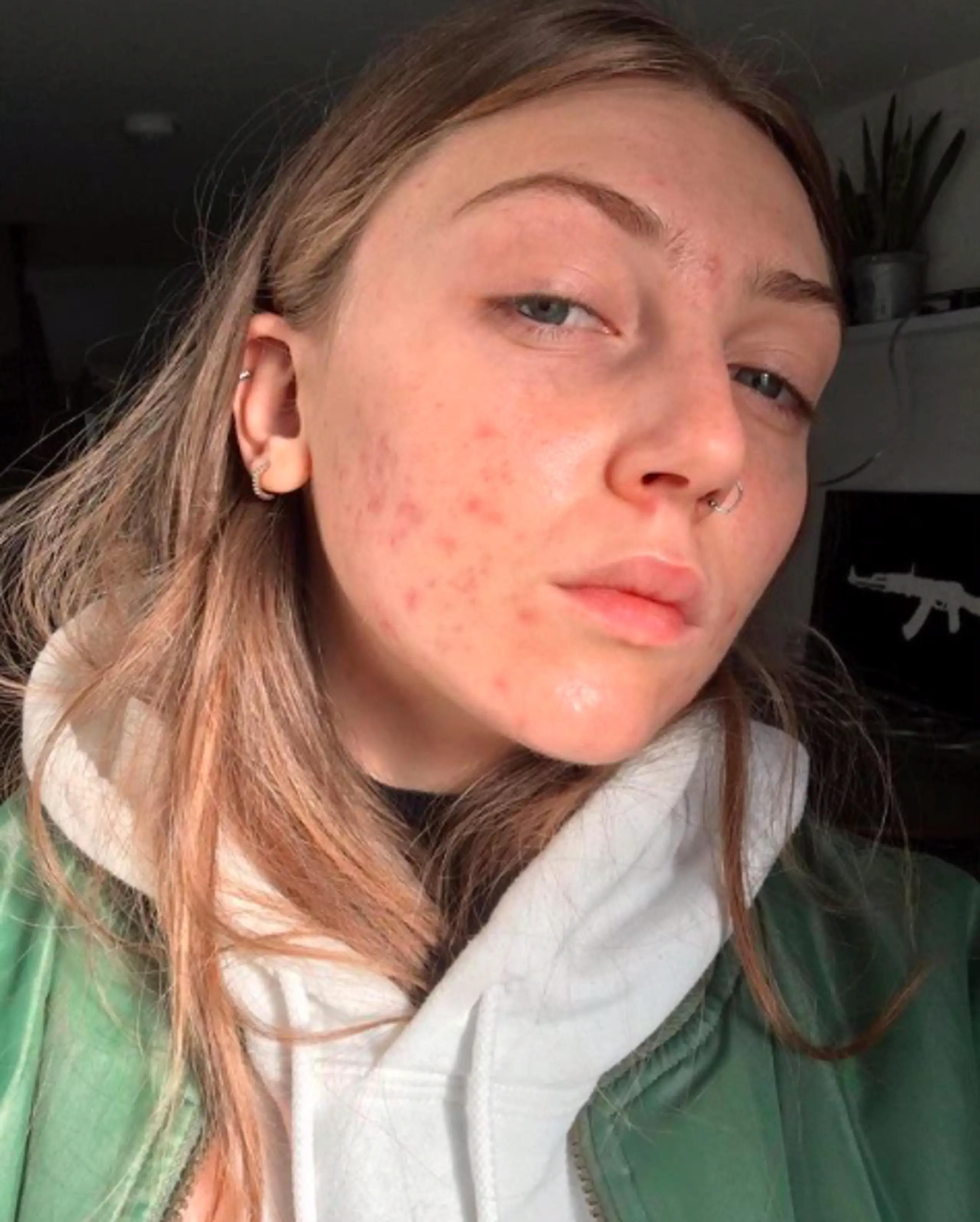 Britains' Next Top Model star Lou Northcote acne (Credit: Instagram)